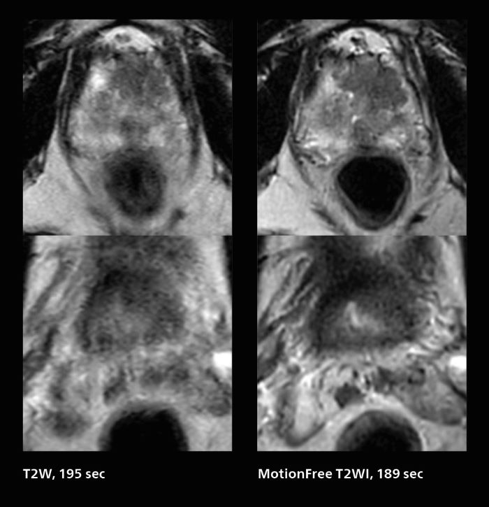 Fast prostate cancer MRI images with motion-free show much better quality than T2W without motion-free, almost similar scan time, mobile one