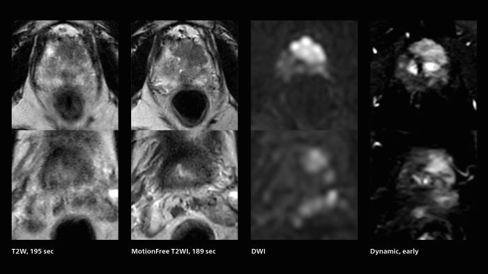 Fast prostate cancer MRI images with motion-free show much better quality than T2W without motion-free, almost similar scan time