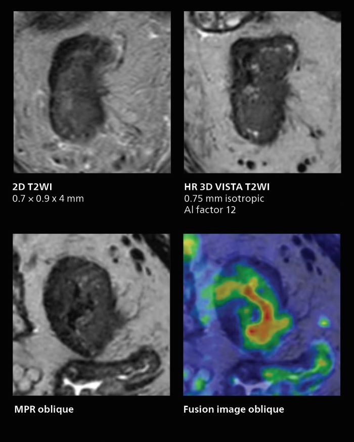 MRI of rectal cancer: fast isotropic 3D acquisitions providing excellent image quality with use of AI-enabled SmartSpeed, mobile one