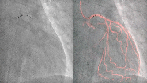Exclusive coronary guidance tools