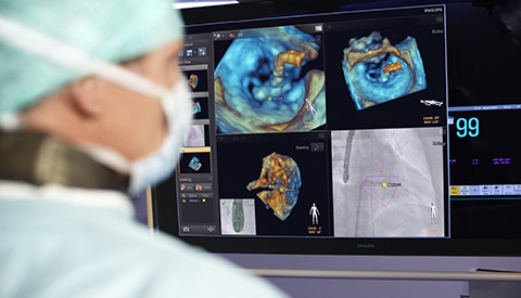 إحداث فرق حقيقي بفضل تقنية التوجيه بالصور المباشرة Philips Live Image Guidance في علاج أمراض القلب الهيكلية&nbsp;&nbsp;